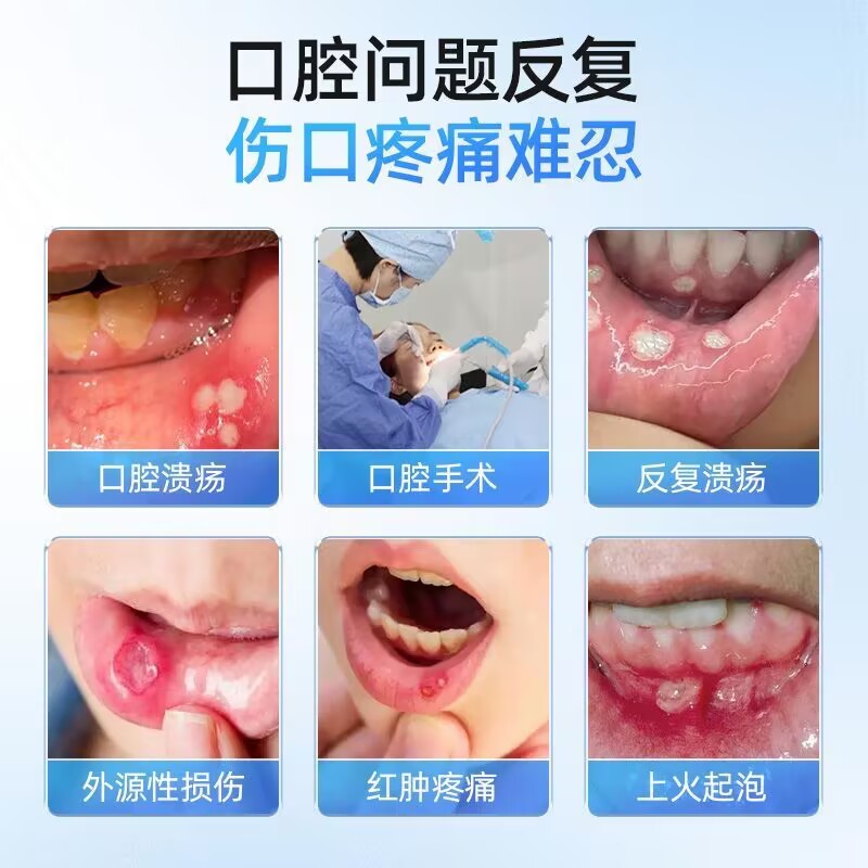 海氏海诺 12片装口腔溃疡膜缓解口腔上火口疮疼痛保护贴口舌起泡创面溃疡保护膜高清大图