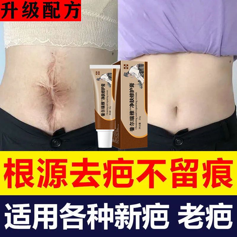 [老疤克星]去疤膏去疤痕修复无痕膏除疤旧疤祛疤膏增生凹凸伤疤 1支试用装[适用新巴]