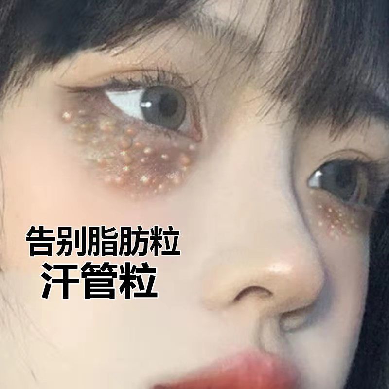 去脂肪粒汗管粒油脂粒神器眼霜祛除眼部黑眼圈脸部颗粒精华液男女 1瓶[送专业棉签]