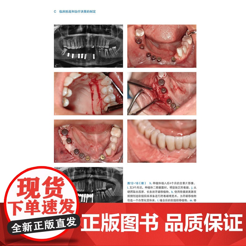 [出版社]口腔种植骨增量手术精要(德)亨德里克·特海登 生物学原则外科手术技巧临床挑战9787559140203辽宁科学高清大图