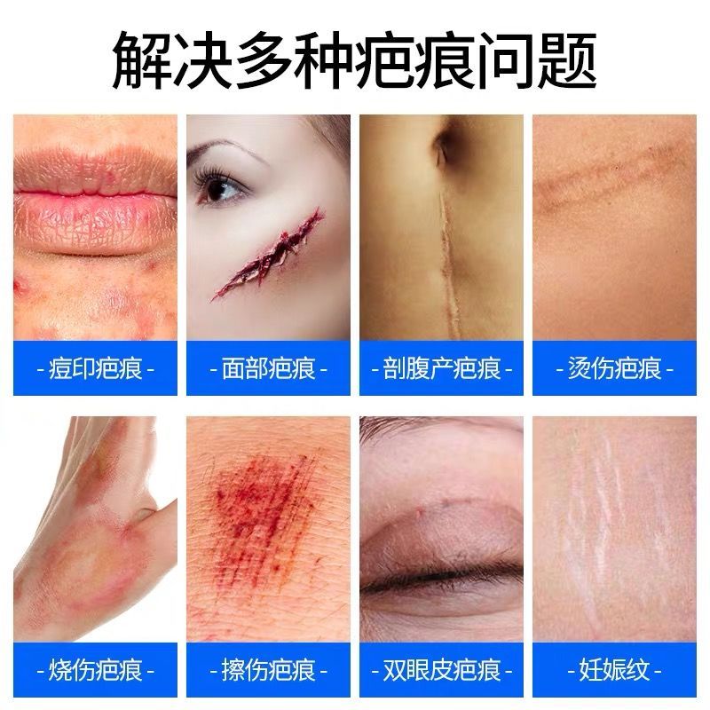 祛疤膏去疤灵除疤膏凹凸疤痕修复霜去手术增生伤疤烫伤痘坑印视频