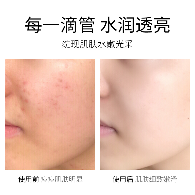 形象美虾青素去痘精华液30ml 滋润保湿补水