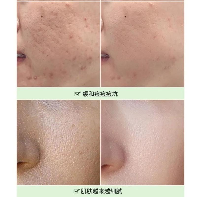 水杨酸清洁泥膜深层清洁去黑头粉刺收缩毛孔控油涂抹式面膜学生IN