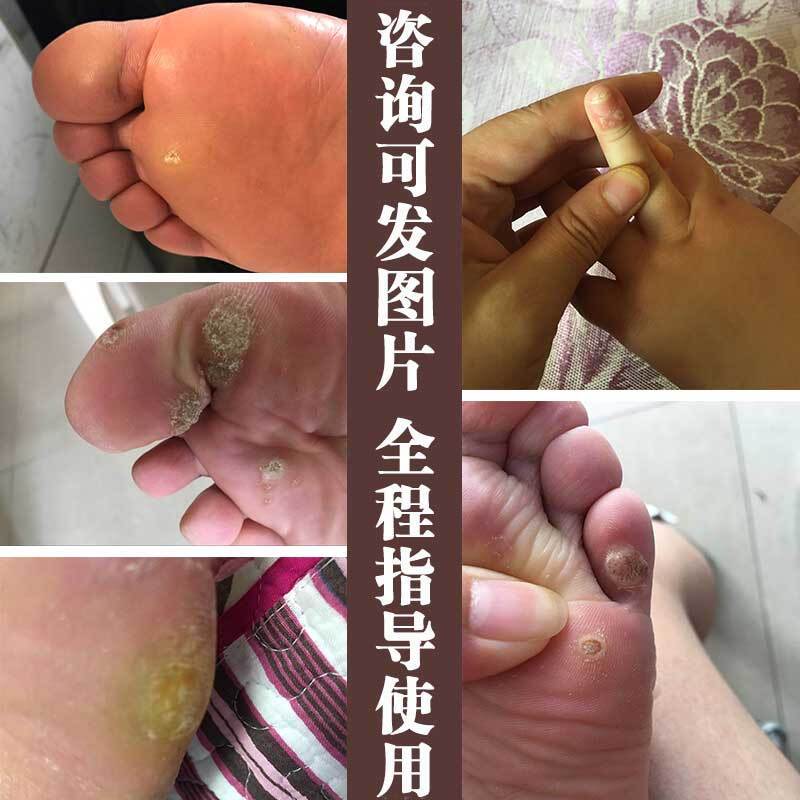 鸡尤泰鸡眼去除茧子死皮肉刺跖尤猴子血泡刺茧手足部鸡尤泰鸡尤康