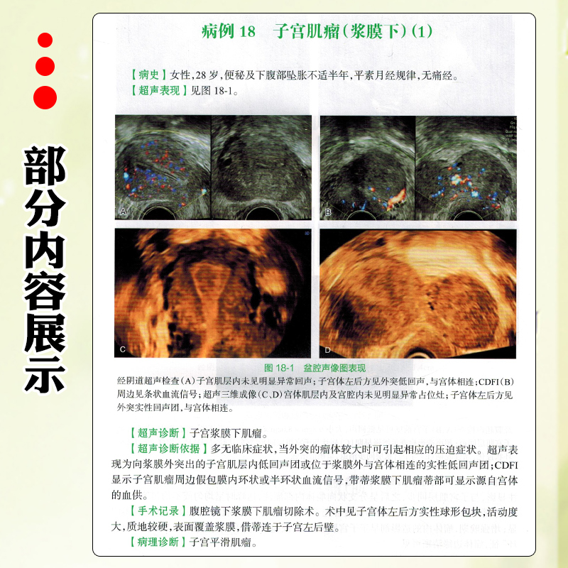 [正版]妇科疾病超声图解100例 人民卫生出版社 9787117346191高清大图