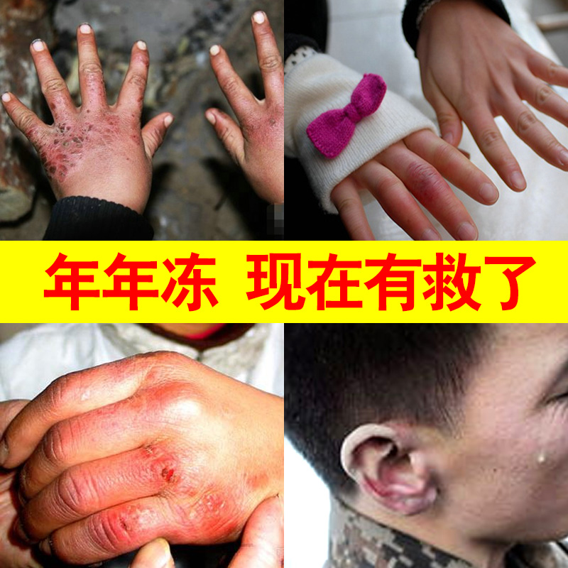 [优选好货]正品云南本草冻疮止冻膏治裂防冻伤皲裂手脚干裂止痒膏脸