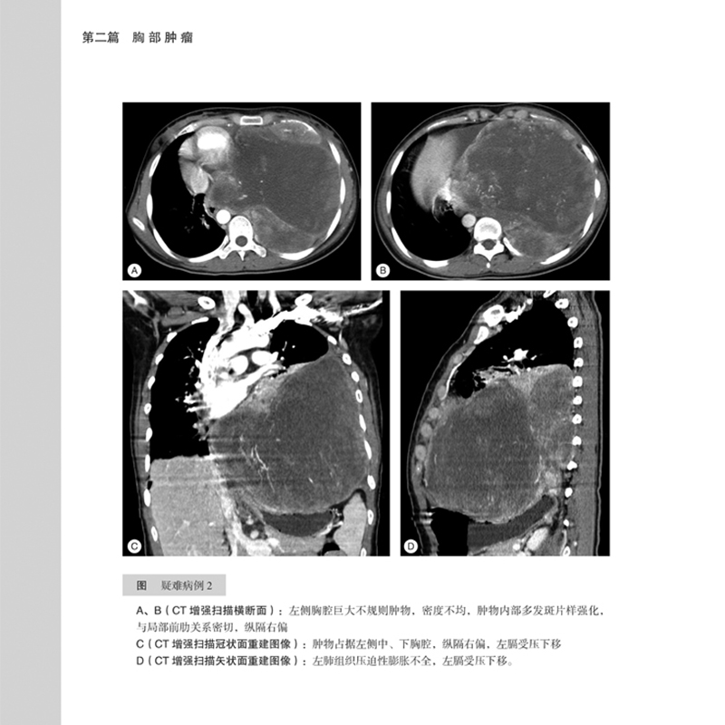 [醉染正版]肿瘤影像诊断图谱 第2版分享中国医学科学院肿瘤医院影像科多年宝贵的诊断与鉴别诊断经验周纯武赵心明主编影像医学高清大图