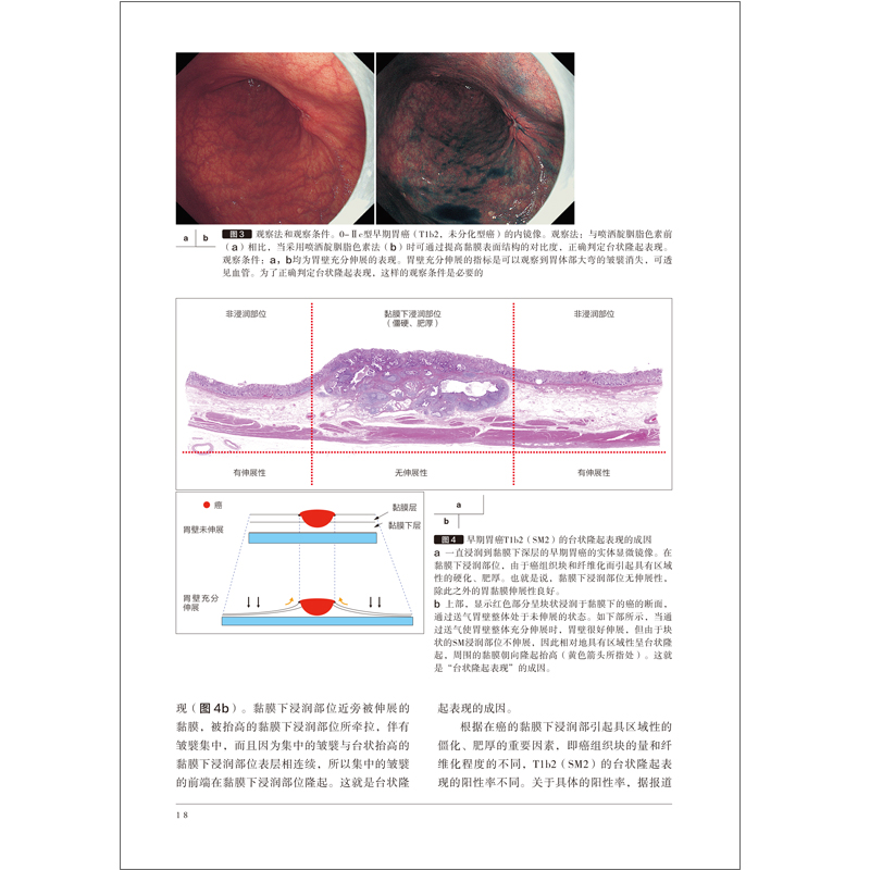 正版新书]早期胃癌的内镜治疗与适应证范围的扩大日本《胃与肠》高清大图