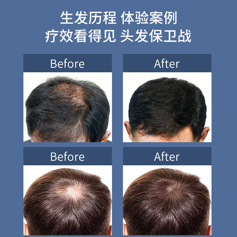 爱满分(Aimanfun)激光生发仪LLLT黑科技激光生发帽生发仪防脱生发帽生发增发密发护发红光治疗仪激光生发头盔高清大图