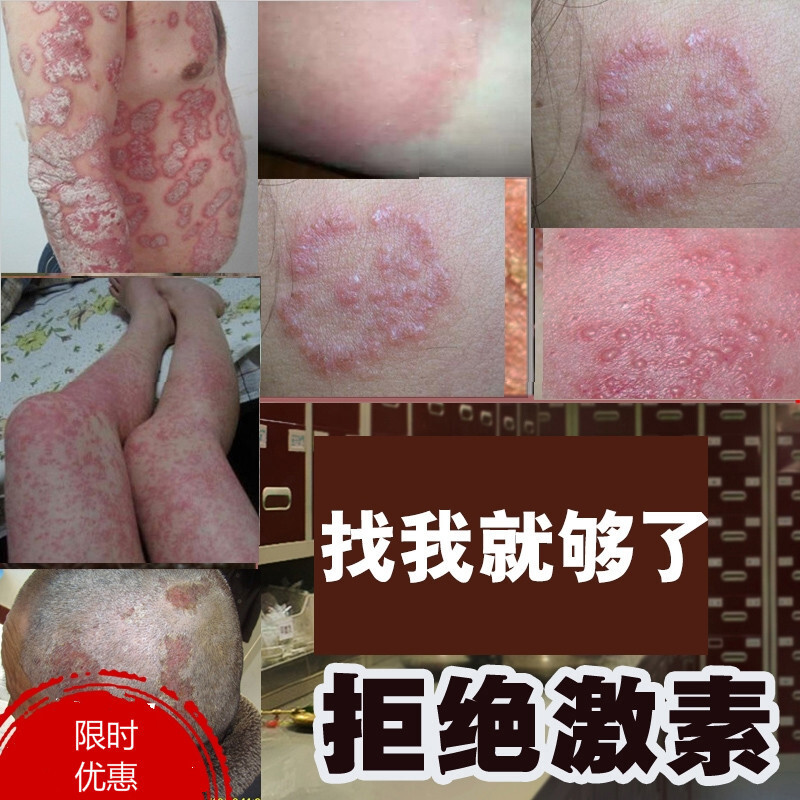 侗彝百草膏达康臣草本乳膏邢刑贵人草本膏侗柠彝百草膏哎艾丹乳膏舒