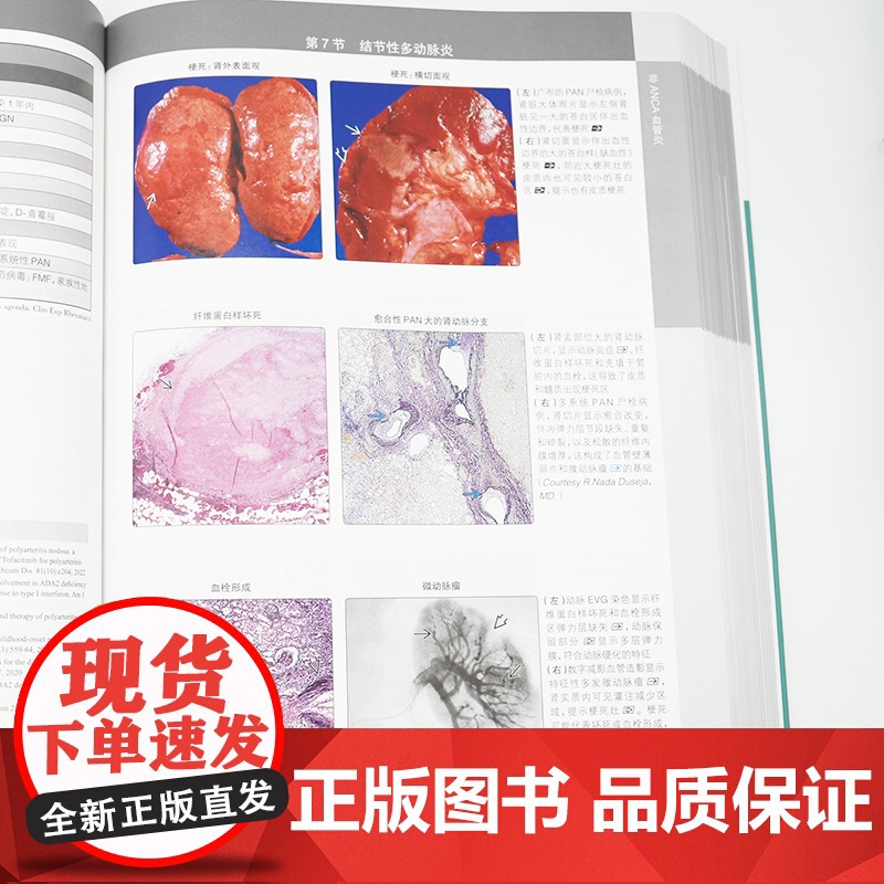 肾脏病理诊断学(翻译版)肾脏感染性疾病肾移植特发性非狼疮“满堂亮”肾病、噬血细胞性肾小球肾炎冷纤维蛋白原肾小球病人民卫生高清大图