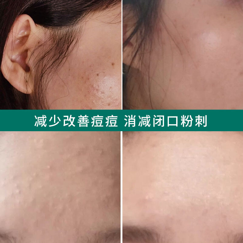 韩国vt老虎水杨酸棉片刷酸祛痘淡化痘印闭口女净透毛孔清洁官方