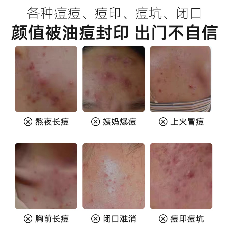 北京同仁堂草本植萃祛痘膏去学生青春痘改善油痘肌护修保湿女男士通用高清大图