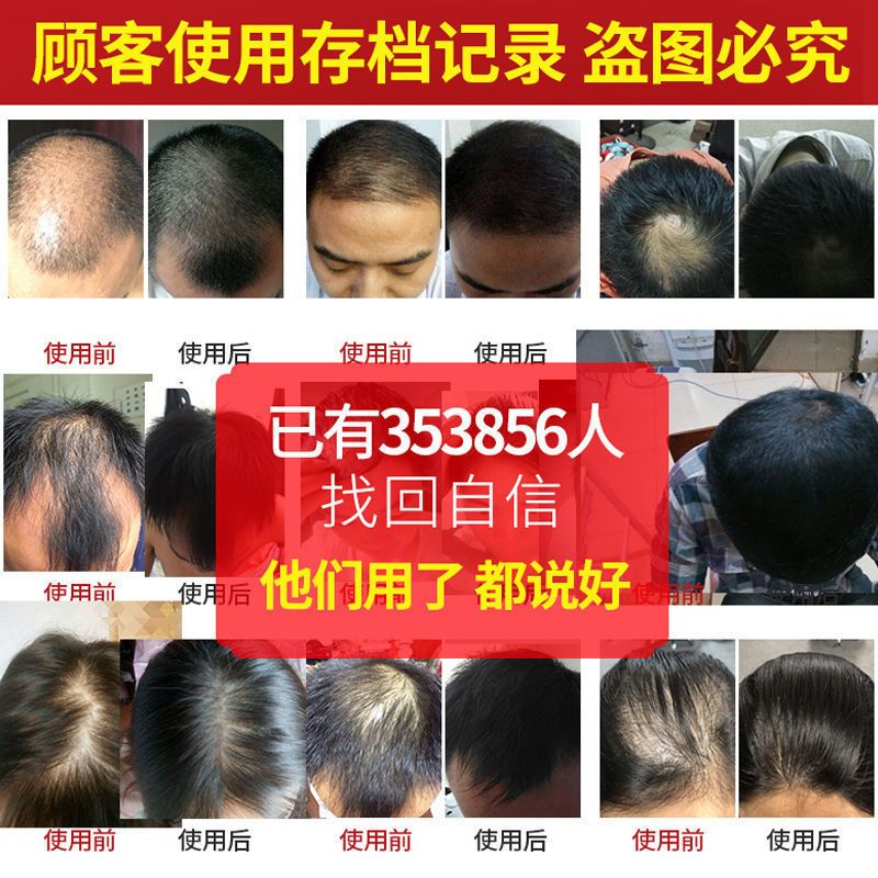 [生新发]育发生发剂增发密发育发液秃顶增长液快速变长头发 单瓶体验装[防脱加生发2000根] 当天生新发 不生发