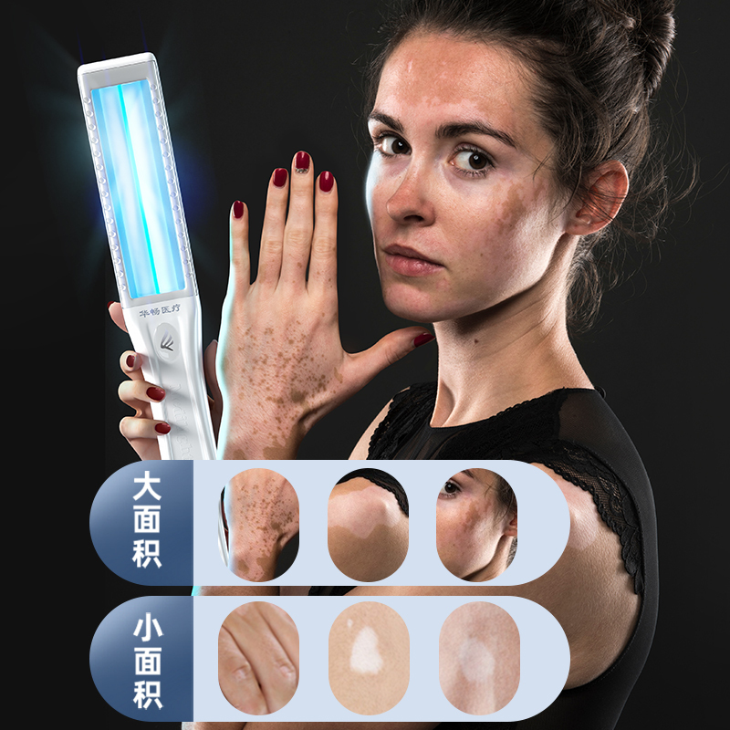 白癜风治疗仪准分子308nm光疗仪紫外线灯家用311uvb银屑病光疗机
