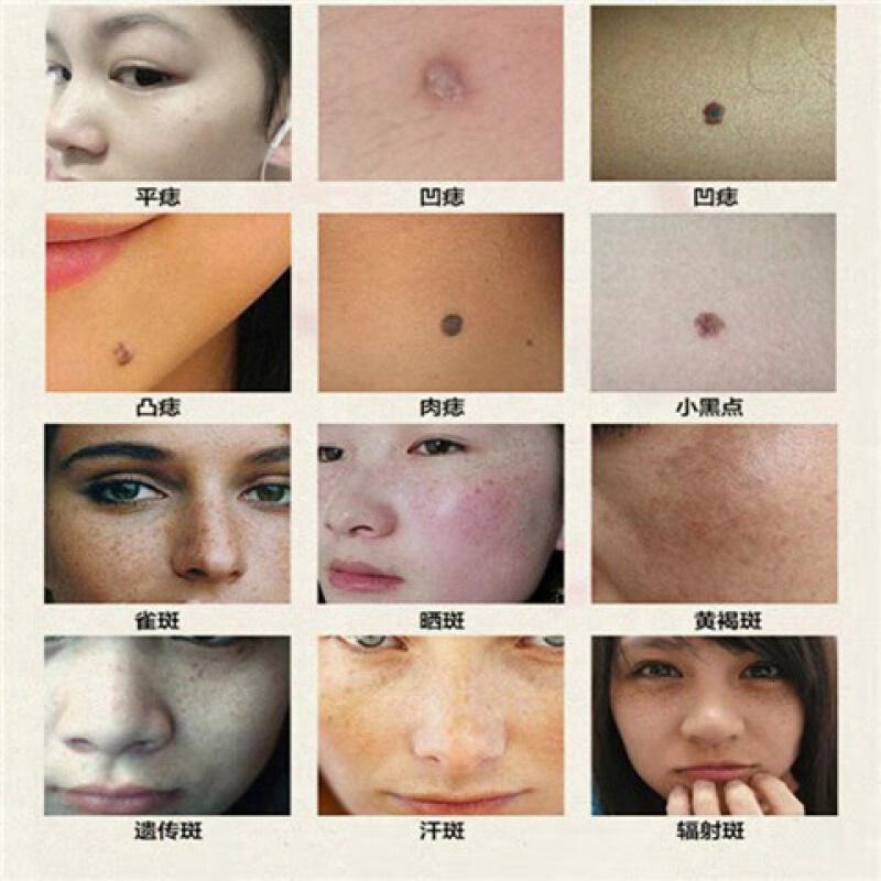 药水点痣水药水无痕脸部黑点痦子丝状疣瘊子去肉痣膏修复