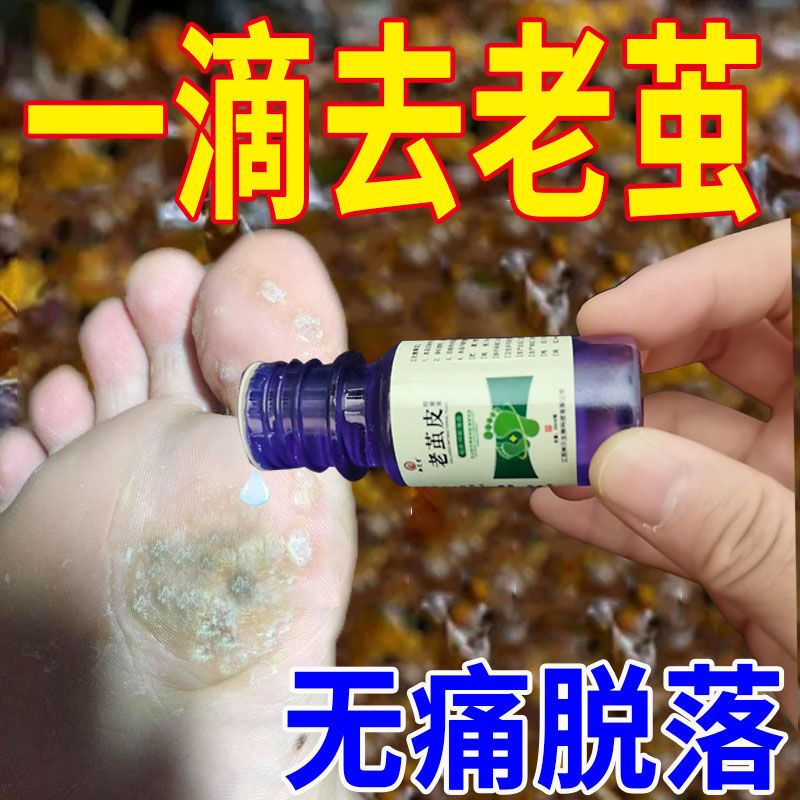 去脚死皮老茧脚后跟老茧去除脚茧厚茧脚趾头关节茧脚底老茧软化膏 1盒试用 收藏商品优先发货