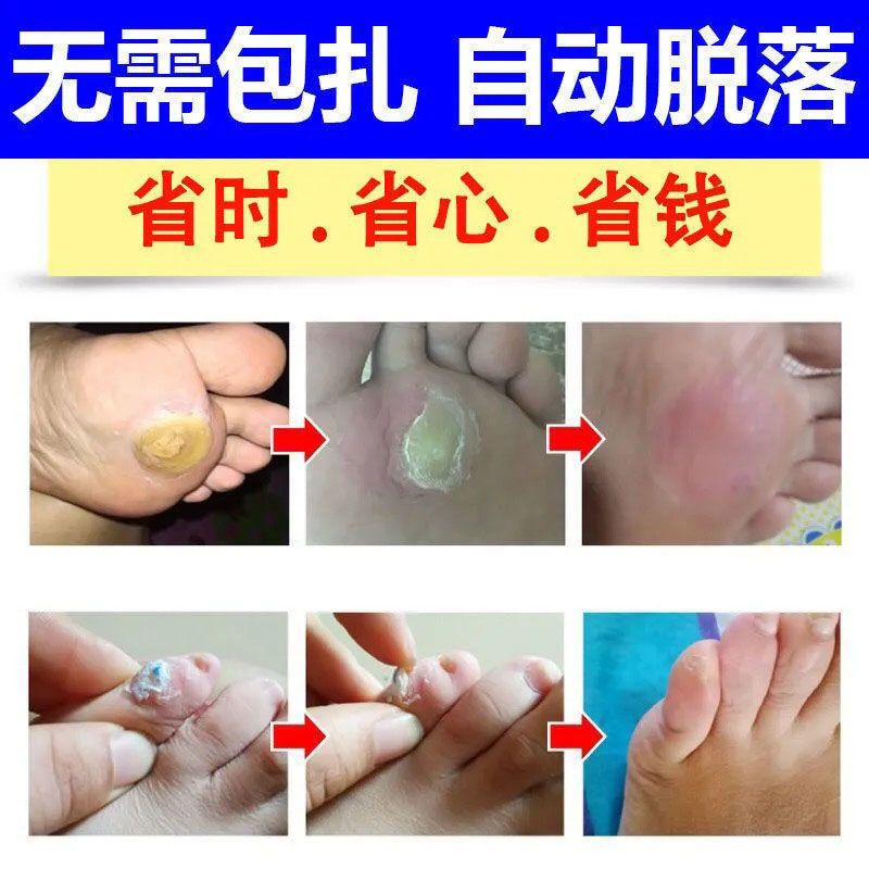 去脚死皮老茧脚后跟老茧去除脚茧厚茧脚趾头关节茧脚底老茧软化膏 1盒试用 收藏商品优先发货