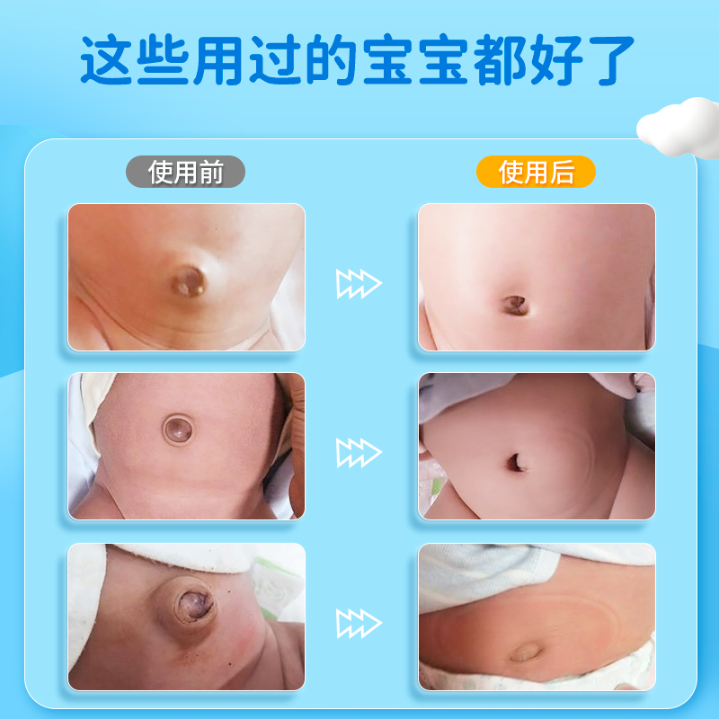 爱护佳脐疝带袋婴幼儿新生儿疝气带医用幼儿护脐小儿凸肚脐贴儿童高清大图