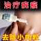 [温和去尤]去除脖子小肉粒皮扁平丝状尤腋下小猴子 (轻度)1盒装