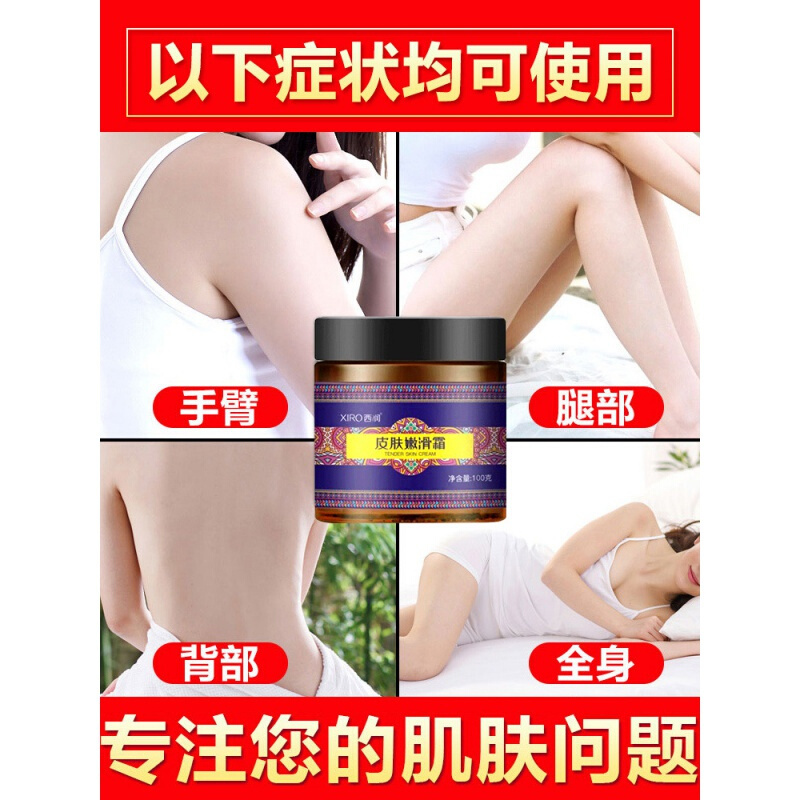 鱼鳞病皮肤霜去鱼鳞鸡皮肤毛囊角质疙瘩角化去除蛇皮鱼鳞腿部病干燥起皮全身体乳霜膏