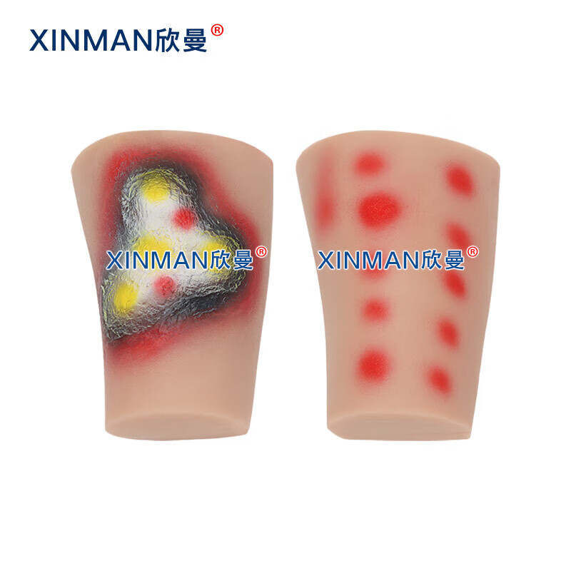 欣曼科教 人员中毒仿真模型 神经性中毒 芥子气中毒 路易氏剂中毒 教学用模型XM-SQ16A高清大图