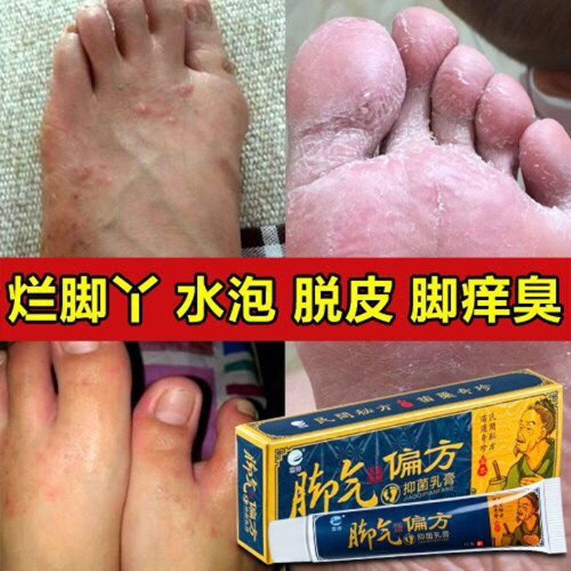 【老中医秘方】3-7天去脚气膏蚊子叮咬止痒草本白色乳膏偏方