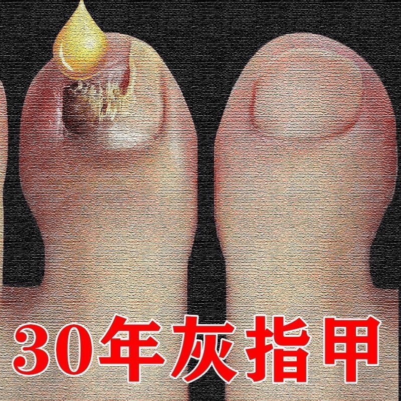 液增厚灰甲亮甲去除灰指甲专用脱甲油抑菌液一瓶[10ml]体验装>800_800