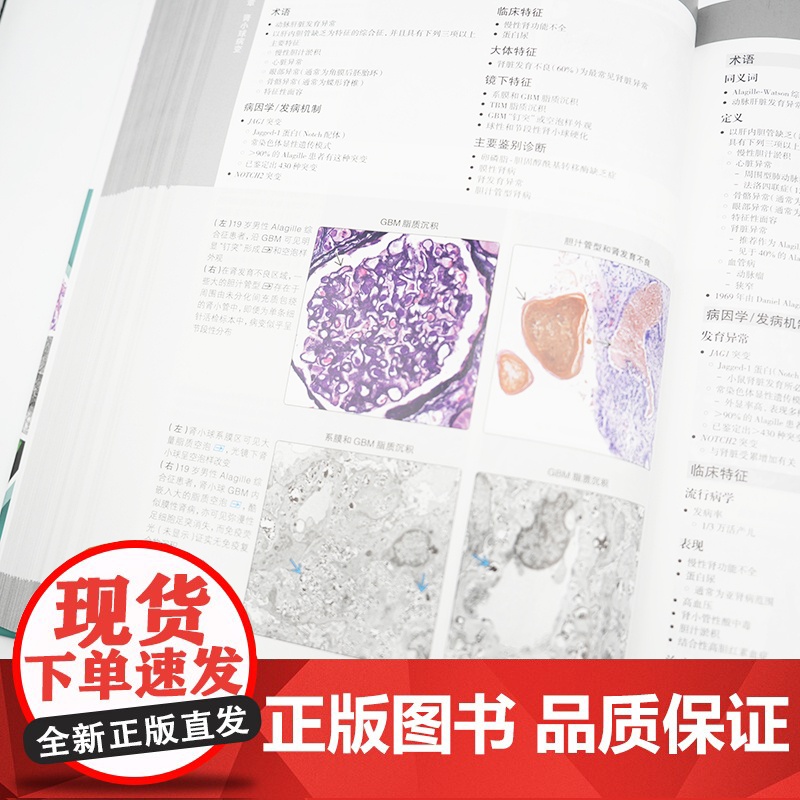 肾脏病理诊断学(翻译版)肾脏感染性疾病肾移植特发性非狼疮“满堂亮”肾病、噬血细胞性肾小球肾炎冷纤维蛋白原肾小球病人民卫生高清大图
