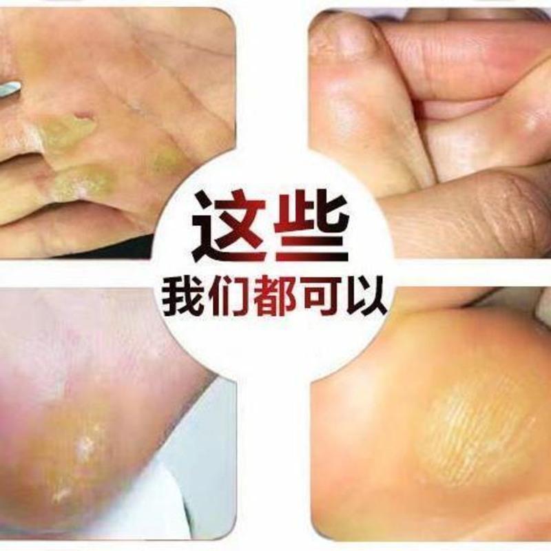 鸡眼软化消除旧茧去除脚茧手茧去脚死皮老茧脚底增厚陈年脚垫老茧鸡眼