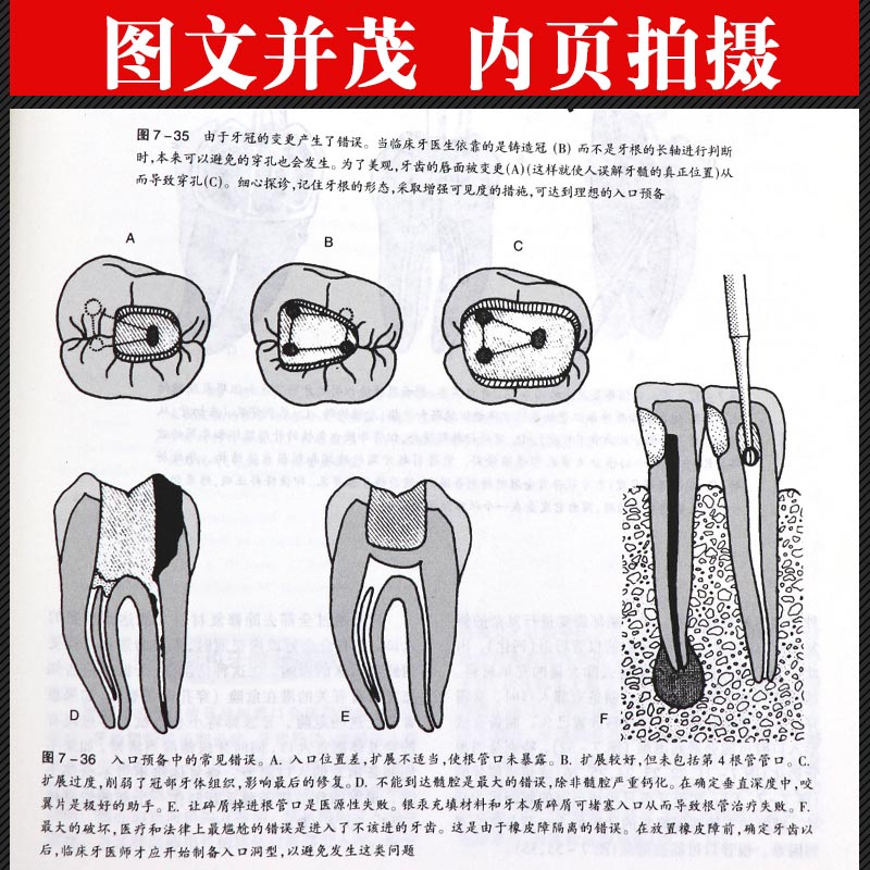 [醉染正版]根管治疗学 牙髓之路 第八版第8版 根管 牙髓 根管诊疗图谱口腔医学著名工具书口腔书籍 李昂主译 97875高清大图