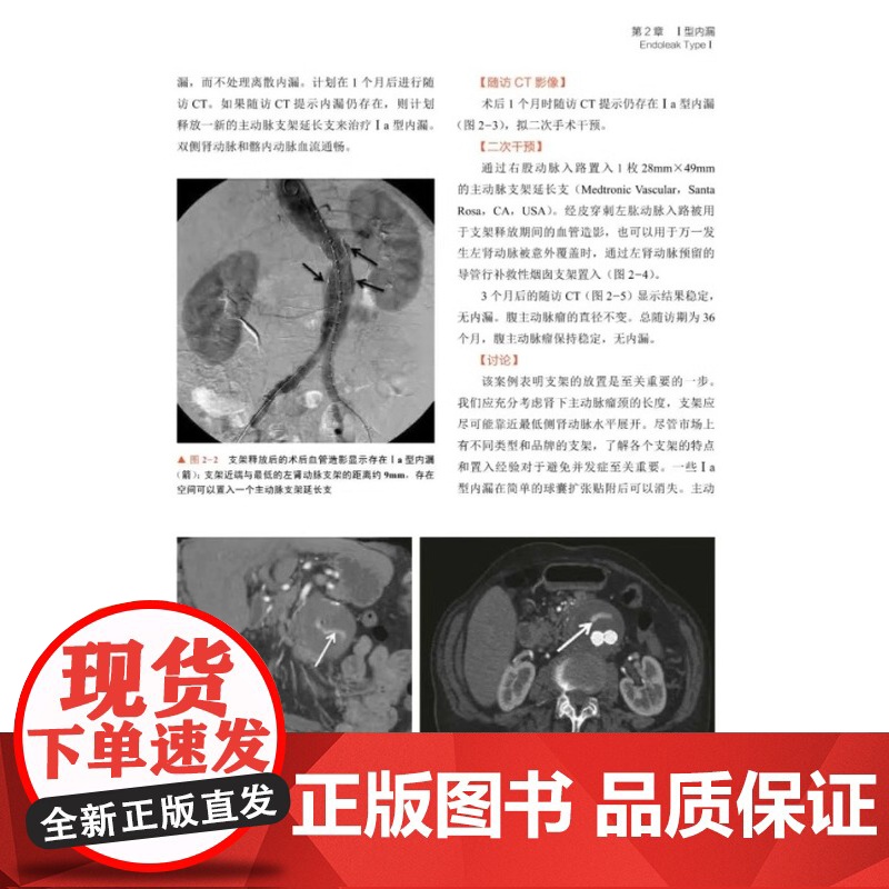 DF[央视网]腹主动脉腔内修复术后内漏治疗:疑难病例精析 9787523601679 中国科学技术出版社 内科学 大动脉高清大图