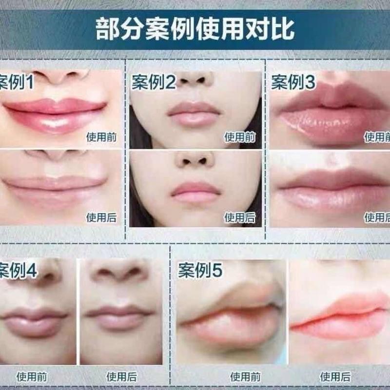 拓芙秘唇部 去嘴唇部去唇周边黑暗沉唇膜去黑色素嘴边学生嘴巴角唇纹精华护理