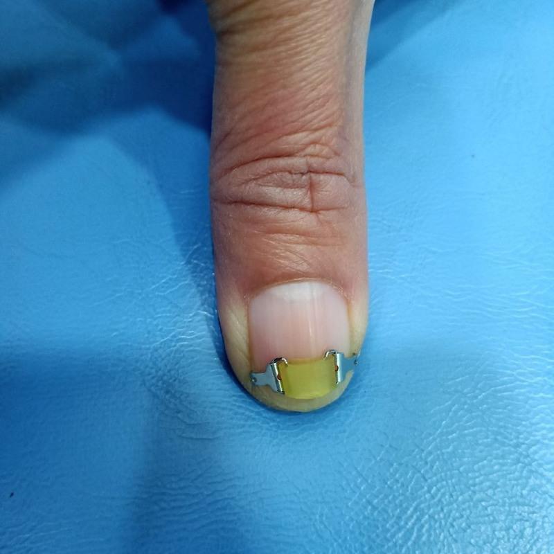 甲沟炎嵌甲矫正器正甲贴 正甲扣指甲矫正器嵌甲矫正贴片指甲矫正 14mm