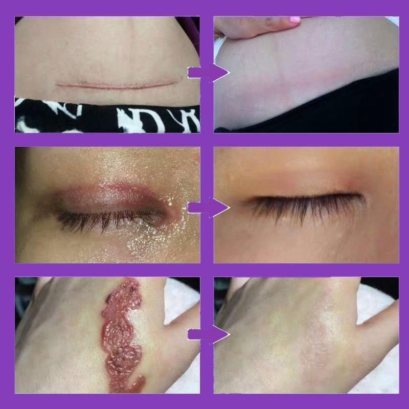 1盒体验装大品牌有保障去疤膏修复疤痕膏祛疤无痕痘印增生凹凸疤克