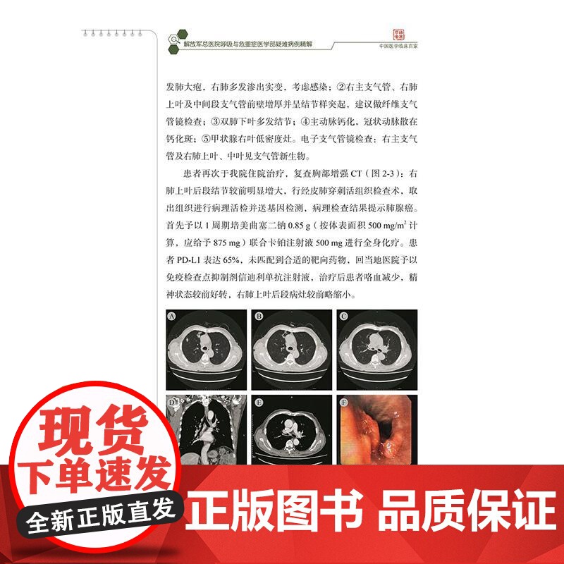 解放军总医院呼吸与危重症医学部疑难病例精解 赵卫国 王韧韬 刘慧莹 主编 黏液表皮样癌等 9787523519295科高清大图