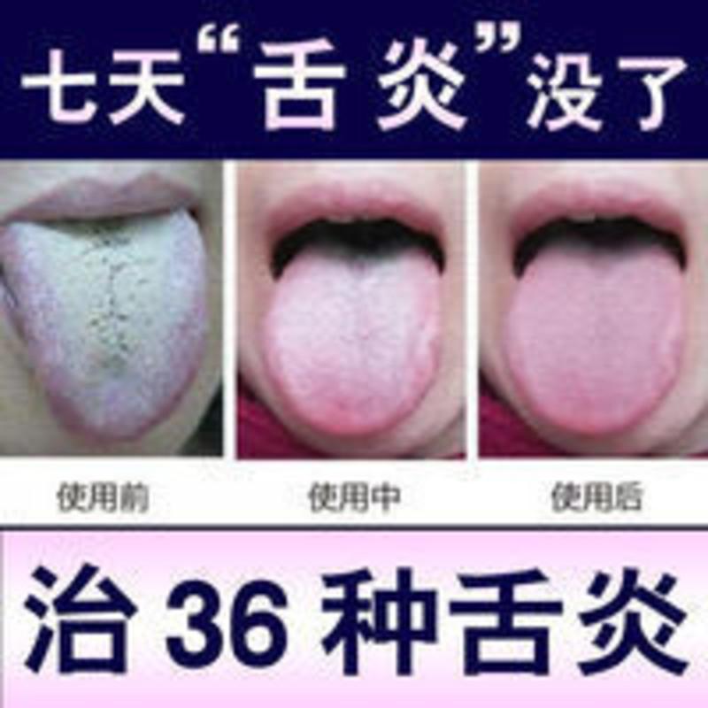 [支持试用]齿痕舌苔发白舌乳头炎舌苔发黑毛舌头干裂沟纹舌糜烂 [支持试用]齿痕舌苔发白舌乳头炎舌苔发黑毛舌头干裂沟纹舌糜