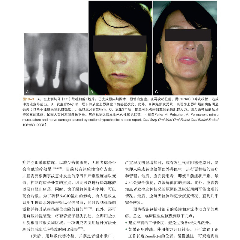 [醉染正版]牙髓之路第11版第十一版牙髓治疗并发症的处理口腔科学书籍医学类专业书籍牙科牙髓治疗根管治疗图谱临床牙髓再生技高清大图
