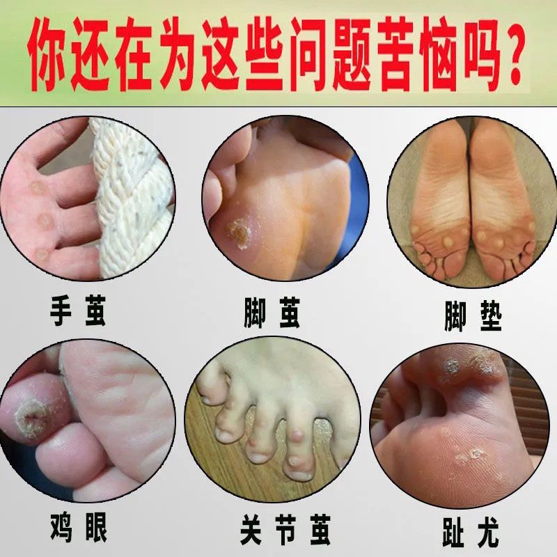 去脚死皮老茧脚后跟老茧去除脚茧厚茧脚趾头关节茧脚底老茧软化膏 1盒试用 收藏商品优先发货