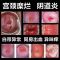 [糜烂拜拜]白带过多妇科炎症引起的阴道炎白带过多异味外阴瘙痒 单盒装