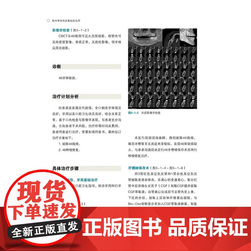 [出版社]黏性骨块临床基础及应用 撒悦 李军 口腔科学书籍 黏性骨块临床应用病例解析 辽宁科学技术出版社 骨缺损重建黏性高清大图