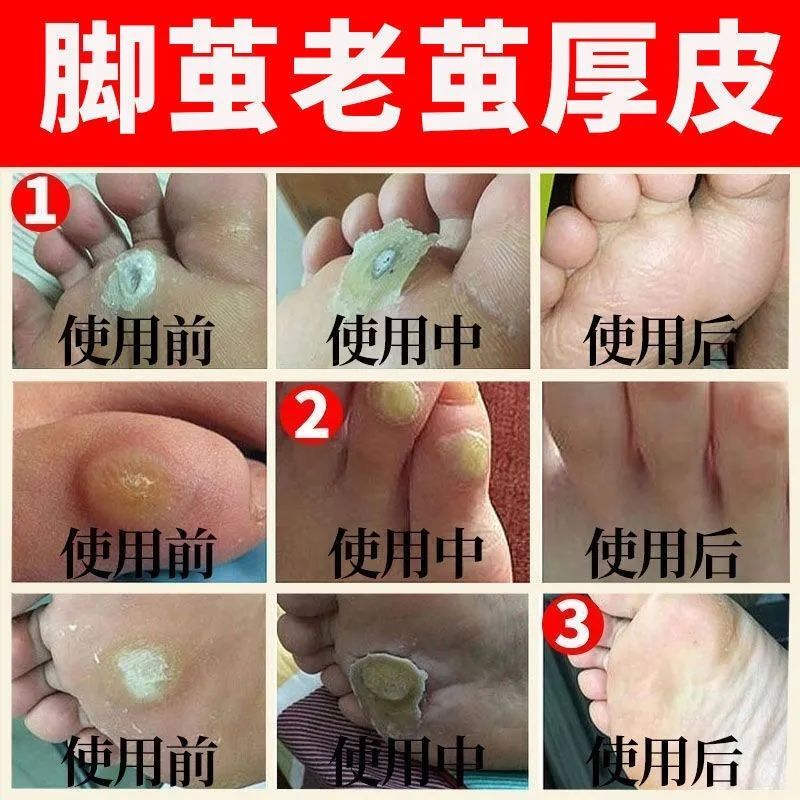 去脚死皮老茧脚底去除手上老茧硬皮脚茧软化剂脚趾头关节茧子神器 1盒体验装