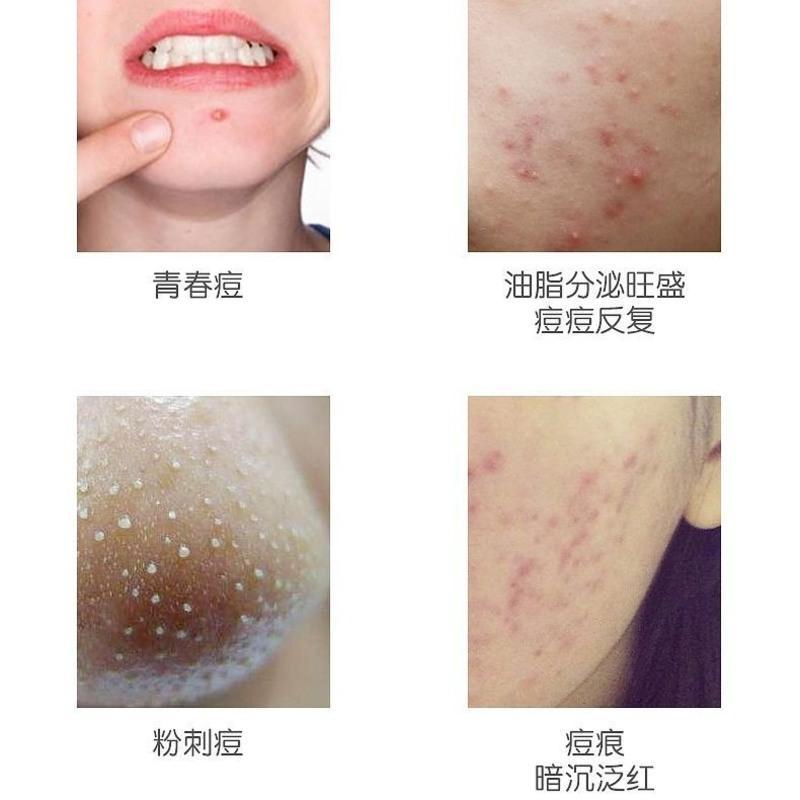 2送1]冰王芦荟清痘膏20g祛痘粉刺青春痘男女痘印修复霜抑菌膏>800_800