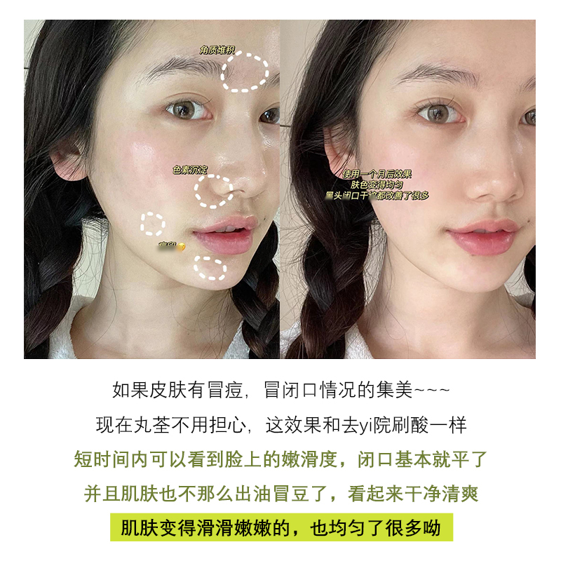 刷酸绿皮书!玻尿酸单支改善闭口收缩毛孔