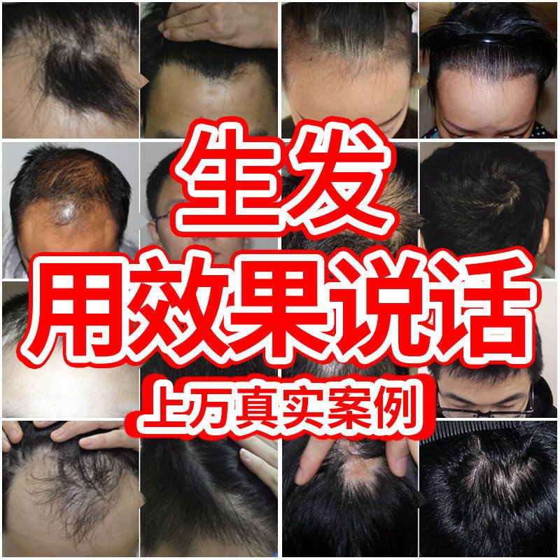 [优先发货][快速长发]防脱发洗发水纯生发增发密发斑秃脂溢性育发液防发 3周期装(严重脱发使用)