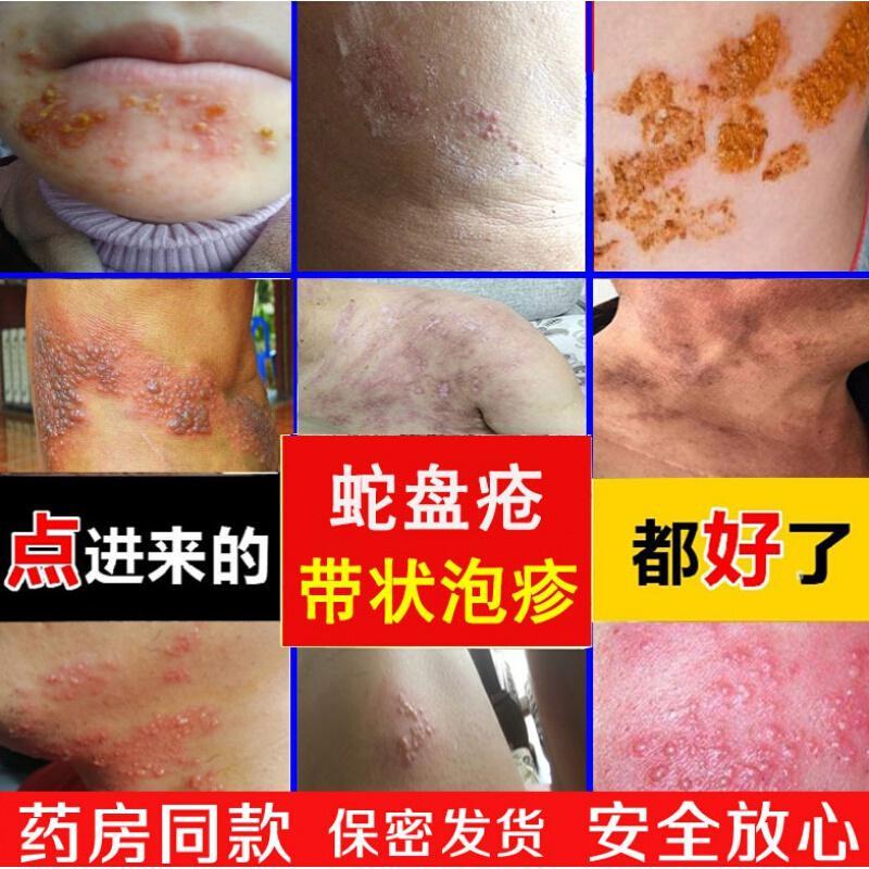 浅米草胡克蛇七号治带状疱疹后遗症神经痛断根蛇盘疮蛇胆疮缠腰火丹