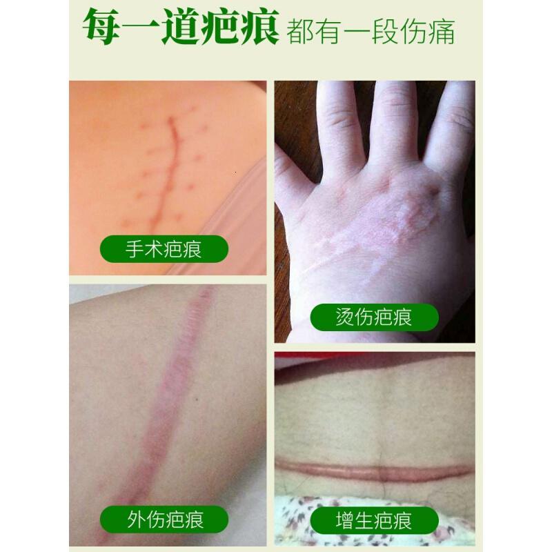 去老疤痕的药膏疤痕除伤疤膏巴凹凸复平膏疤痕修复脸部手术去疤膏印FL
