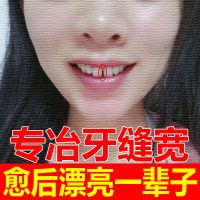牙缝宽大[固齿合缝]修复牙龈萎缩牙齿松动出血上火牙黄牙痛牙膏
