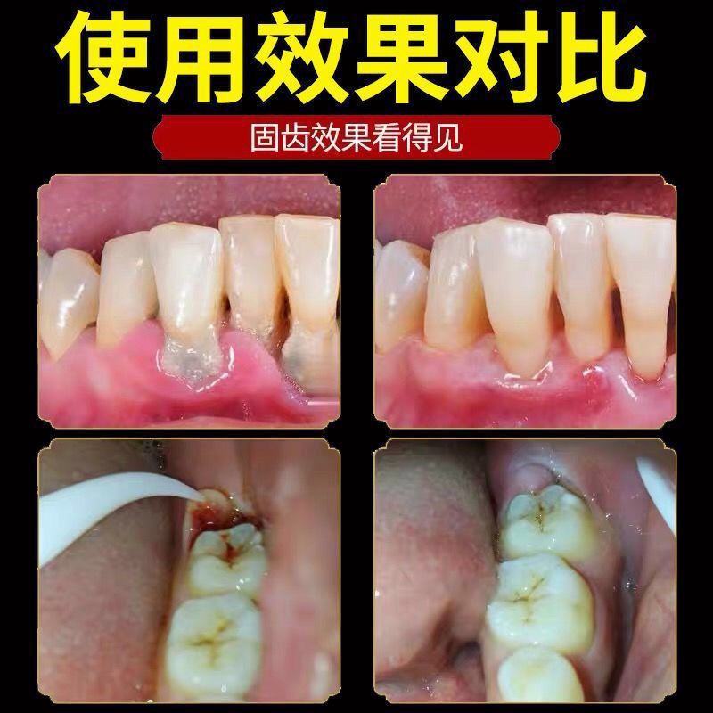 [固齿专用]牙齿松动牙龈萎缩牙周炎护理牙膏治牙缝宽抗敏感牙膏 [收藏
