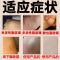 脂肪瘤消贴[1贴消溜]去皮下脂肪瘤贴多单发性硬块纤维粉瘤 [单盒]6贴装